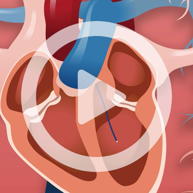 C-Cath vidéo d'animation - apercu